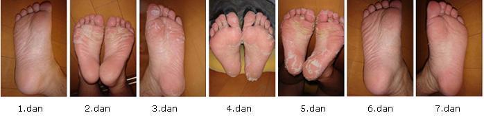 Baby Foot gel nogavičke 2 kosa - za odstranjevanje trde kože na stopalih 2 primer